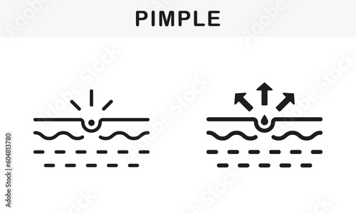 Pimple Line and Silhouette Black Icon Set. Blackhead, Deep Pustule Skin Problem Symbol Collection. Skin Acne, Inflammation Sebum, Comedo Pictogram. Isolated Vector Illustration