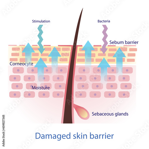 Damaged skin barrier vector on white background. The sebum barrier decreased, tight arrangement between the skin cells is lost. Skin care and beauty concept illustration.