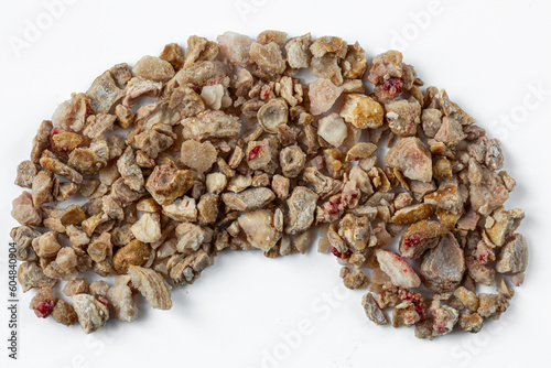 Kidney stones. Stones were removed from the patient's kidneys