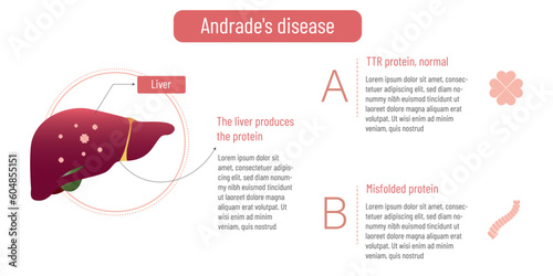 Andrade's disease. Misfolded TTR protein