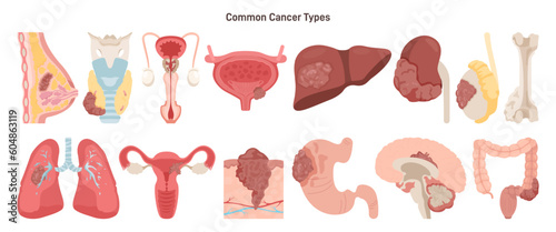 Common cancer types set. Breast, lung, stomach, ovarian, bone