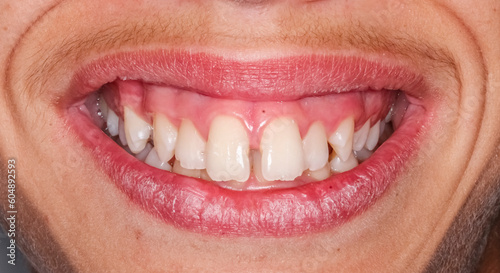 Dental maxillary and mandibular arches in occlusion with biting teeth, diastema gap between central incisors. Healthy gingival gum and no decay. 
