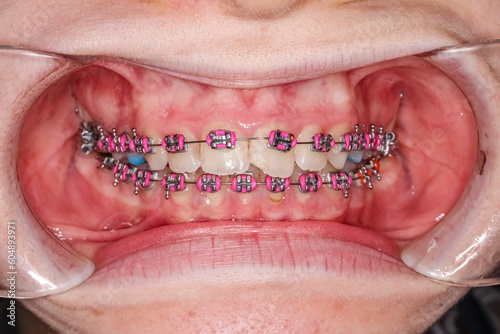 Dental orthodontic braces with pink colored elastic ligatures front view biting maxillary. Orthodontics teeth alignment treatment patient case with anterior crooked teeth and fractured central incisor
