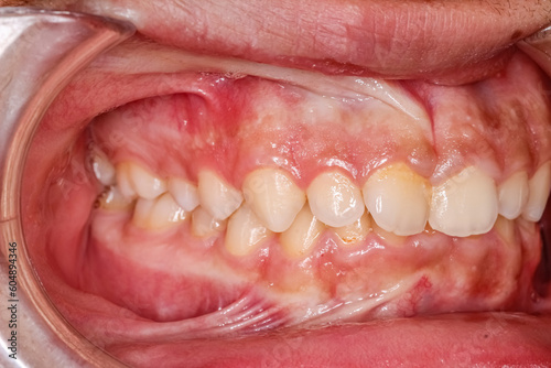 Dental maxillary and mandibular arches in occlusion with biting crooked anterior central incisors teeth. Oblique direct side view with cheek retractor, gingival gum frenulum.