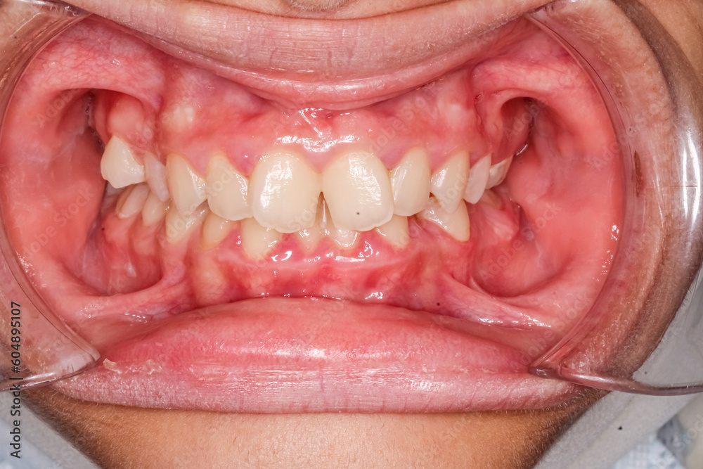 Dental maxillary and mandibular arches in occlusion with biting teeth