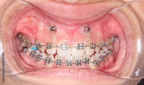 Frontal view of dental arches in biting teeth occlusion, orthodontic braces, elastic O-ring ligature and arch wire. Mini-implants in healthy gingival gum, lips retracted with cheek retractor.