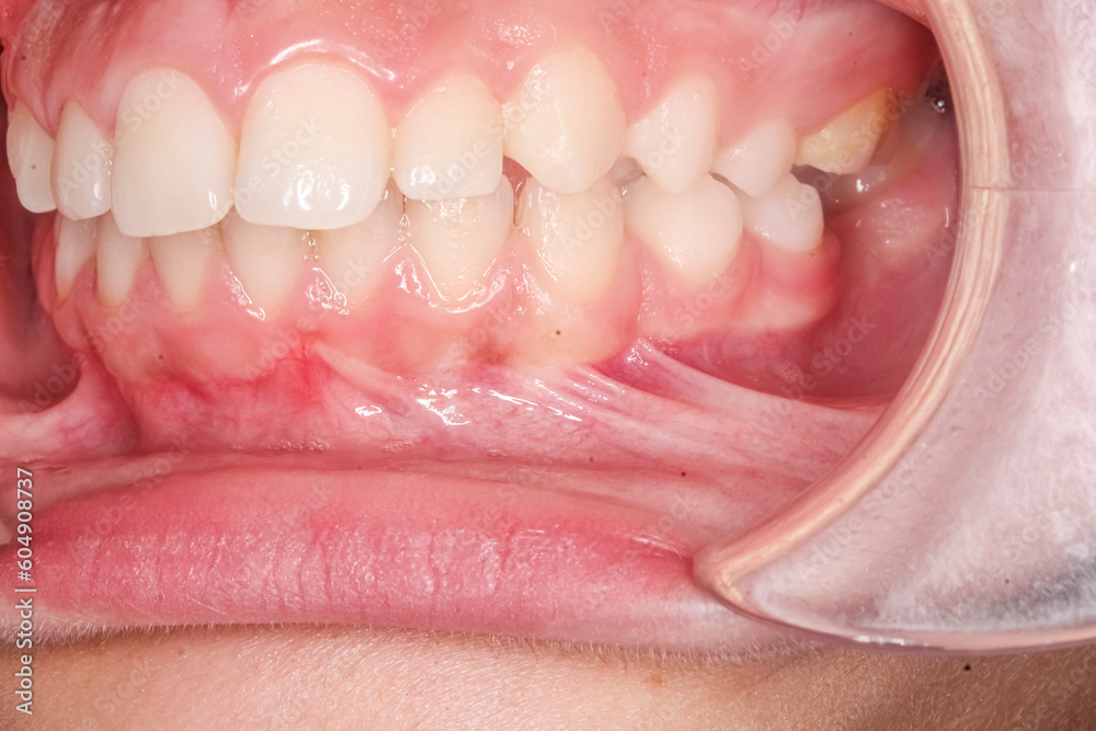 Frontal view of dental maxillary and mandibular arches in occlusion