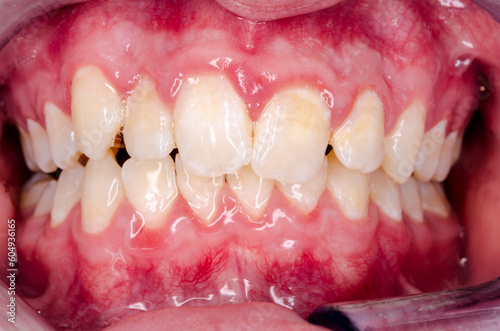 young person with gingivitis