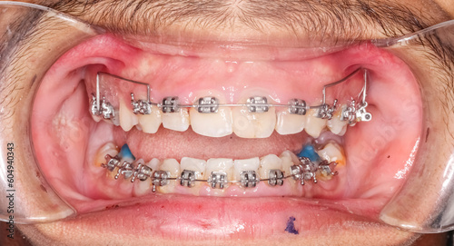 Frontal view of open mouth dental arches with deep overbite biting teeth, bite-raising blue resin on molars , orthodontic braces, metallic arch wire, cheeks and lips retracted with cheek retractor. 