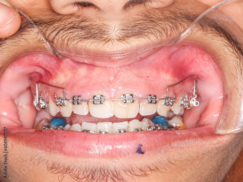 Frontal view of open mouth dental arches with deep overbite biting teeth, bite-raising blue resin on molars , orthodontic braces, metallic arch wire, cheeks and lips retracted with cheek retractor.  photo