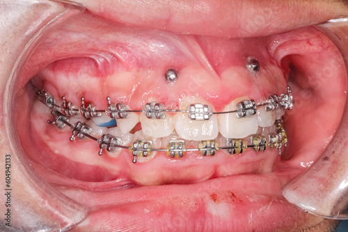Oblique view of dental arches in biting teeth occlusion, orthodontic braces, elastic O-ring ligature, arch wire, cheeks and lips retracted with cheek retractor. Mini-implants in healthy gingival gum.