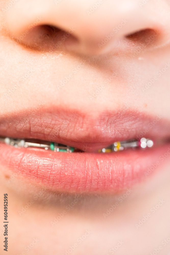 Fototapeta premium Little girl with rainbow braces