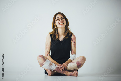 Foto スタジオでモデルをする髪の長い表皮水疱症の女性