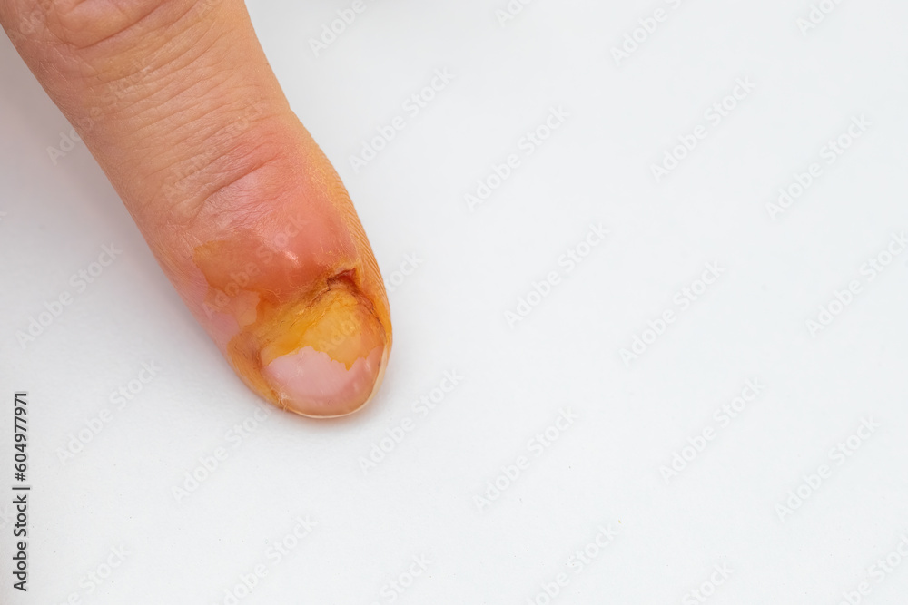 Inflammation of the finger. Managing Finger Inflammation. Inflammation of the finger. Managing Finger Inflammation.