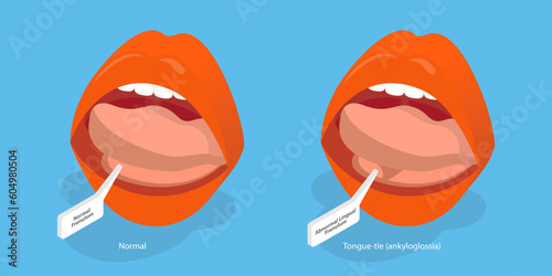 3D Isometric Flat Vector Conceptual Illustration of Ankyloglossia, Short Lingual Frenum That Interferes with Normal Tongue Movement.