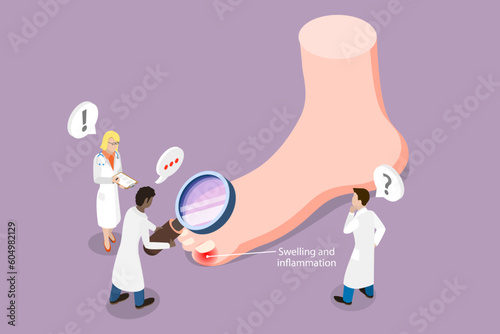 3D Isometric Flat Vector Conceptual Illustration of Ingrown Toenail, Swollen Toe
