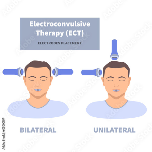 Electroconvulsive therapy for severe depression treatment. ECT electrodes placement on male patient. Brain stimulation equipment for bipolar and major depressive disorders. Vector medical illustration