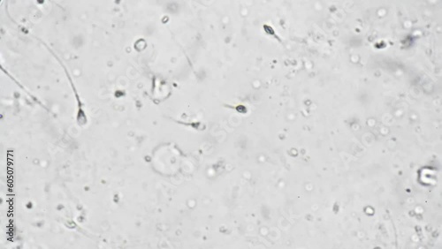 Sperm from the semen of middle-aged man under a microscope magnification 1000 times. A medical fertility reproduction test for a man suffering from the disease. Biological sample of human spermatozoa