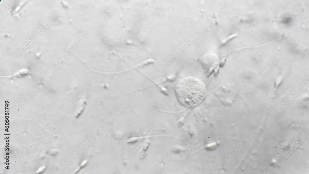Sluggish spermatozoa of sick man in medical spermogram test under microscope at magnification 1000. Problems with fertility and conception of offspring in males. Biological sample of human spermatozoa