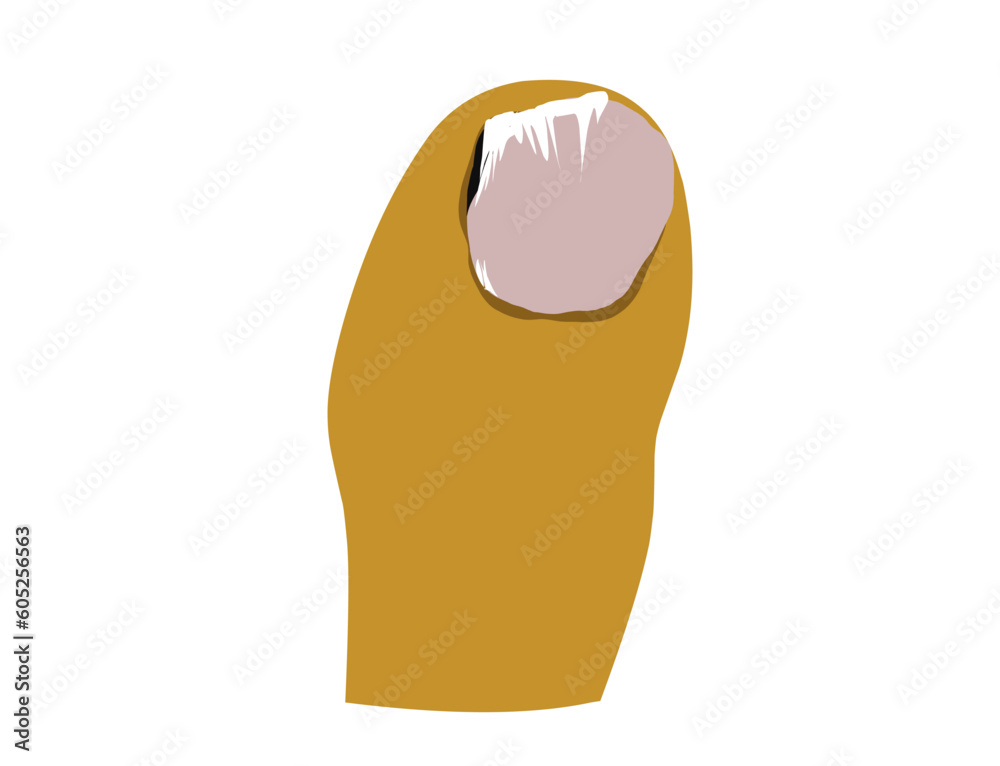vector illustration of brittle nails, The grooves and protrusions on