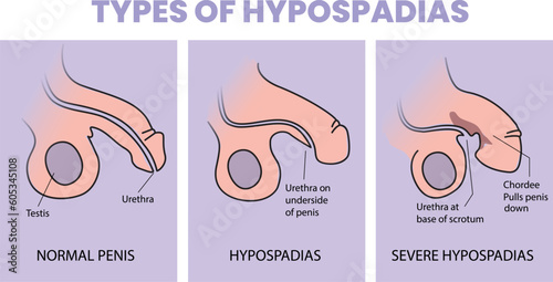 types of hypospadias illustration