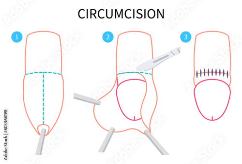 Circumcision paraphimosis for phimosis swelling of medical anatomy pain with HSV and HPV or Herpes simplex virus Redness itchy prepuce Genital candidiasis yeast bacteria preputial adhesion photo