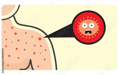illustration of skin disease caused by bacteria or germs