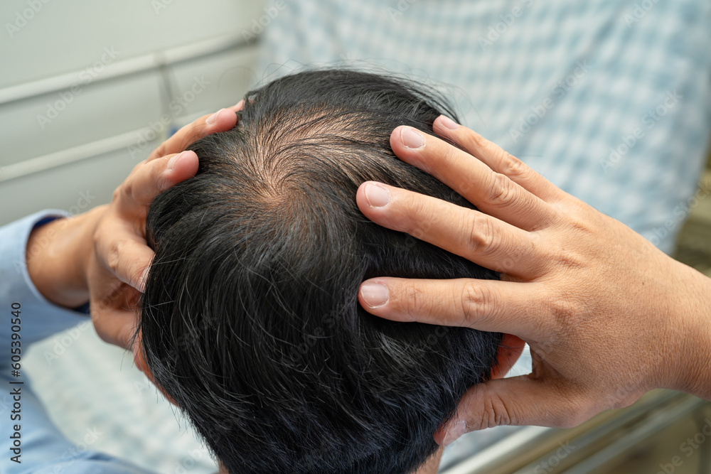 Fototapeta premium Bald in the middle head and begin no loss hair glabrous of mature Asian business smart active office man.