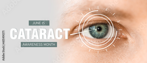 Eye of young man, closeup. Banner for Cataract Awareness Month