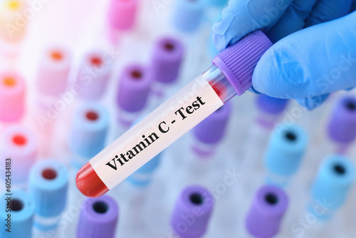 Doctor holding a test blood sample tube with Vitamin С test on the background of medical test tubes with analyzes.Banner.Copy space for text photo