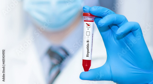 Doctor holding a test blood sample tube positive with hepatitis B virus (HBV) test.Banner.