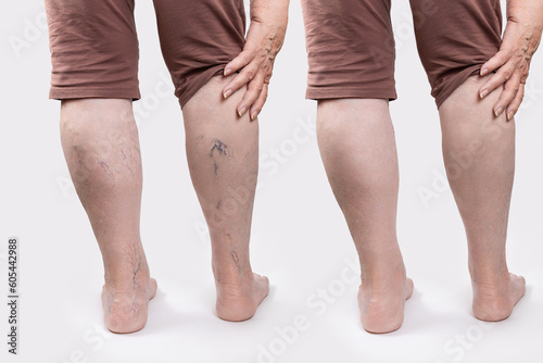 Varicosity. Close up of woman old legs with vascular asterisks. Rear view. Results before and after laser treatment. White background. The concept of varicose veins