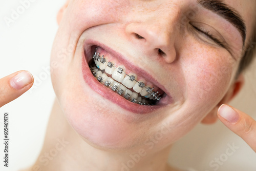 Close-up portrait of a young woman pointing at a smile with braces on her teeth.