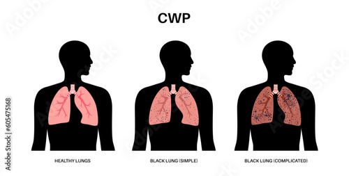 Coal workers disease