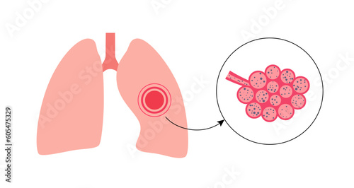 Pneumoconiosis lung disease