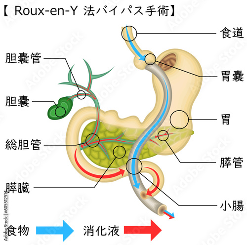 Roux-en-Y法バイパス手術　イラスト