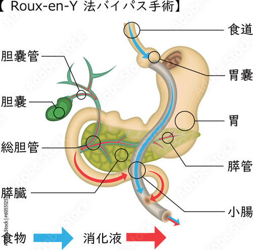 Roux-en-Y法バイパス手術　イラスト