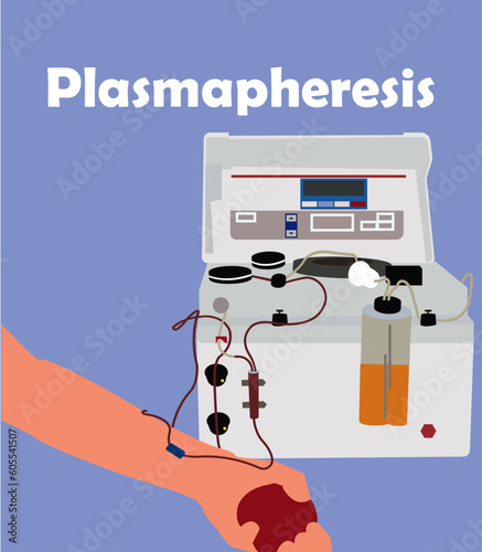 Plasma Exchange (Plasmapheresis) Vector Art photo