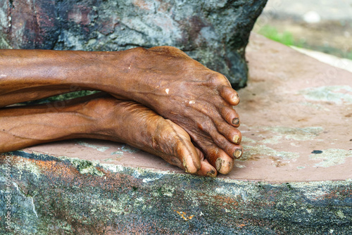 Feet of an old man with long and damaged nails and dry skin