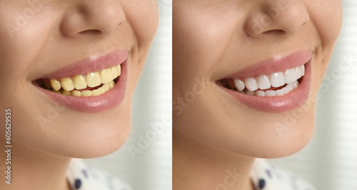 Collage with photos of woman before and after tooth whitening, closeup