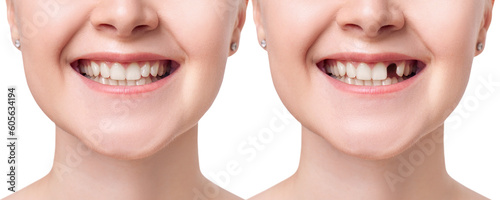 Fotografiet Young woman smiling before and after dental implant.