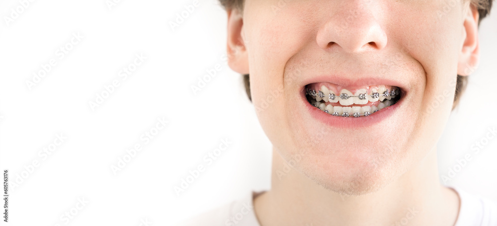 Obraz premium A teenager with dental braces holds interdental brush for cleaning teeth.