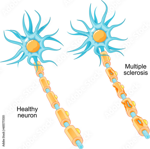 Multiple sclerosis. autoimmune disease