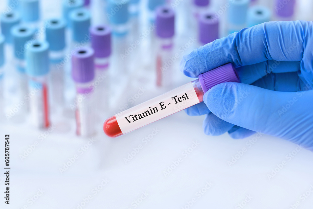Doctor holding a test blood sample tube with Vitamin E test on the background of medical test tubes with analyzes.Banner.Copy space for text Doctor holding a test blood sample tube with Vitamin E test on the background of medical test tubes with analyzes.Banner.Copy space for text