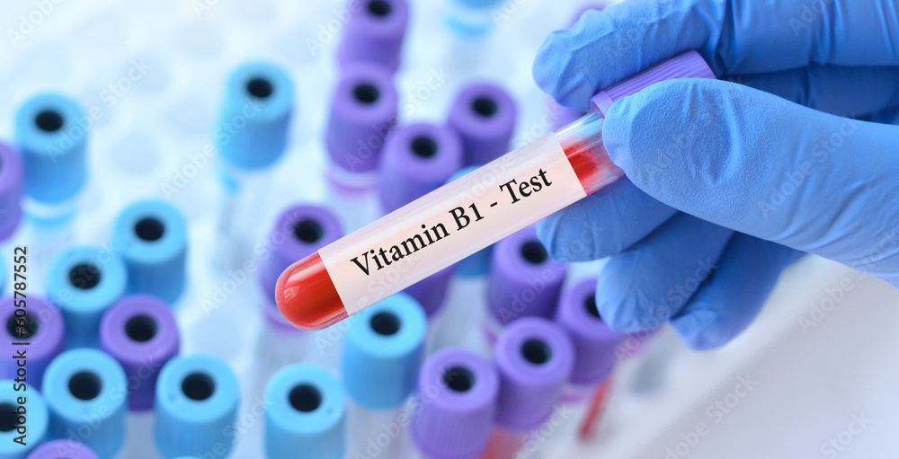 Naklejka premium Doctor holding a test blood sample tube with Vitamin B1 test on the background of medical test tubes with analyzes.Banner.Copy space for text