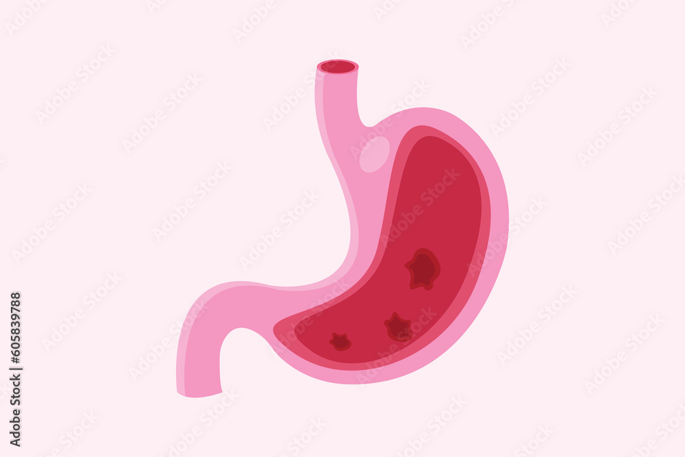 indigestion. Stomach ulcer. gerd. Anatomical vector illustration of the stomach ulcer. illustration for education. eps 10 indigestion. Stomach ulcer. gerd. Anatomical vector illustration of the stomach ulcer. illustration for education. eps 10