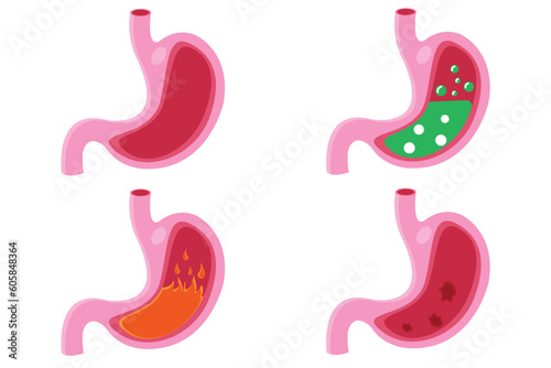 Stomach icon set, cartoon vector illustration. cross section of  normal and abnormal stomach. isolated on white background. eps 10