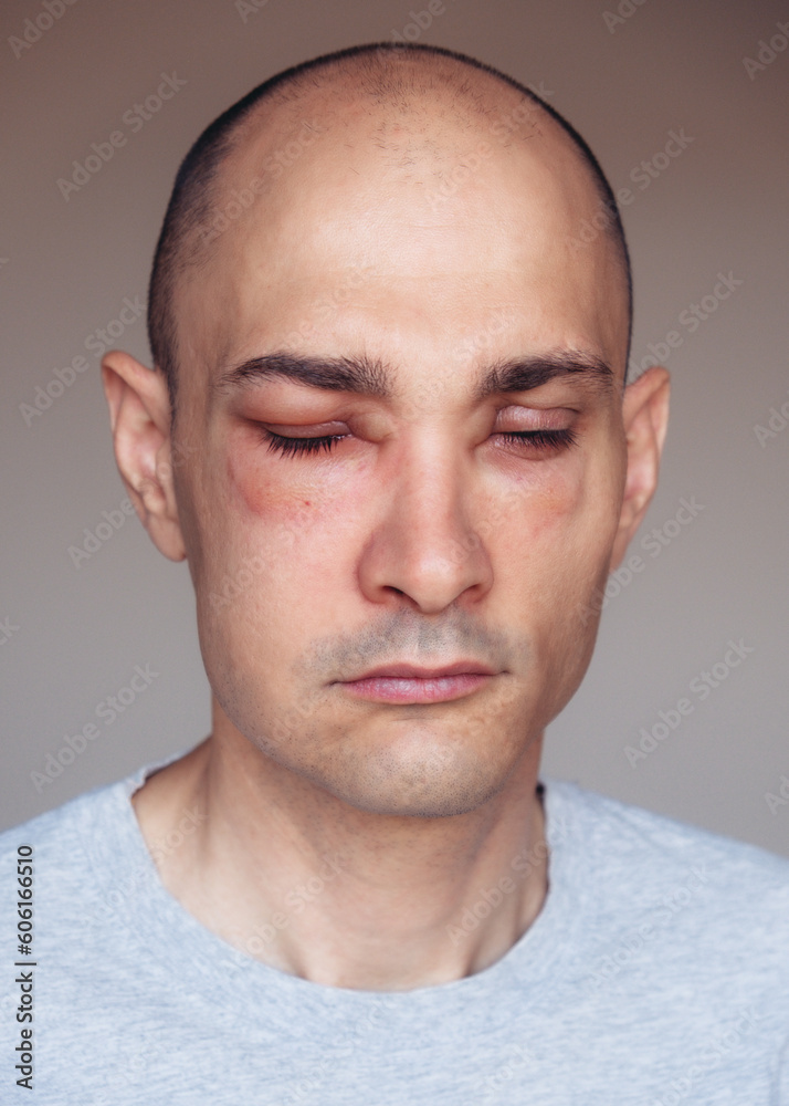 Obraz premium Caucasian man has angioedema around the eyes caused by allergic reaction to agents such as insect bites, foods, or medications. Swollen face.