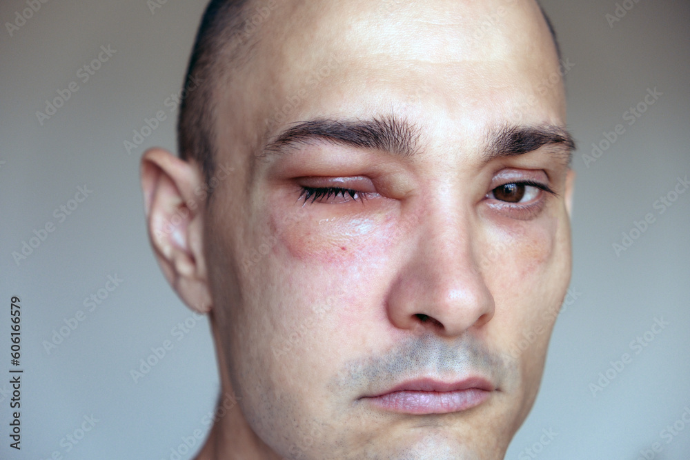 Obraz premium Caucasian man has angioedema around the eyes caused by allergic reaction to agents such as insect bites, foods, or medications. Swollen face, close up.