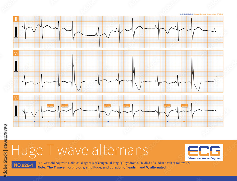A 4-year-old boy with intermittent QT prolongation, huge T wave electrical alternation and frequent premature ventricular beats and ventricular tachycardia on Holter recording. A 4-year-old boy with intermittent QT prolongation, huge T wave electrical alternation and frequent premature ventricular beats and ventricular tachycardia on Holter recording.